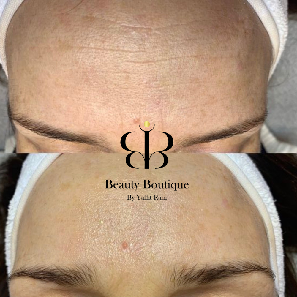 מיקרופלזמה מבוססת RF לעומת RF Microneedling: מה ההבדל בין הטכנולוגיות?