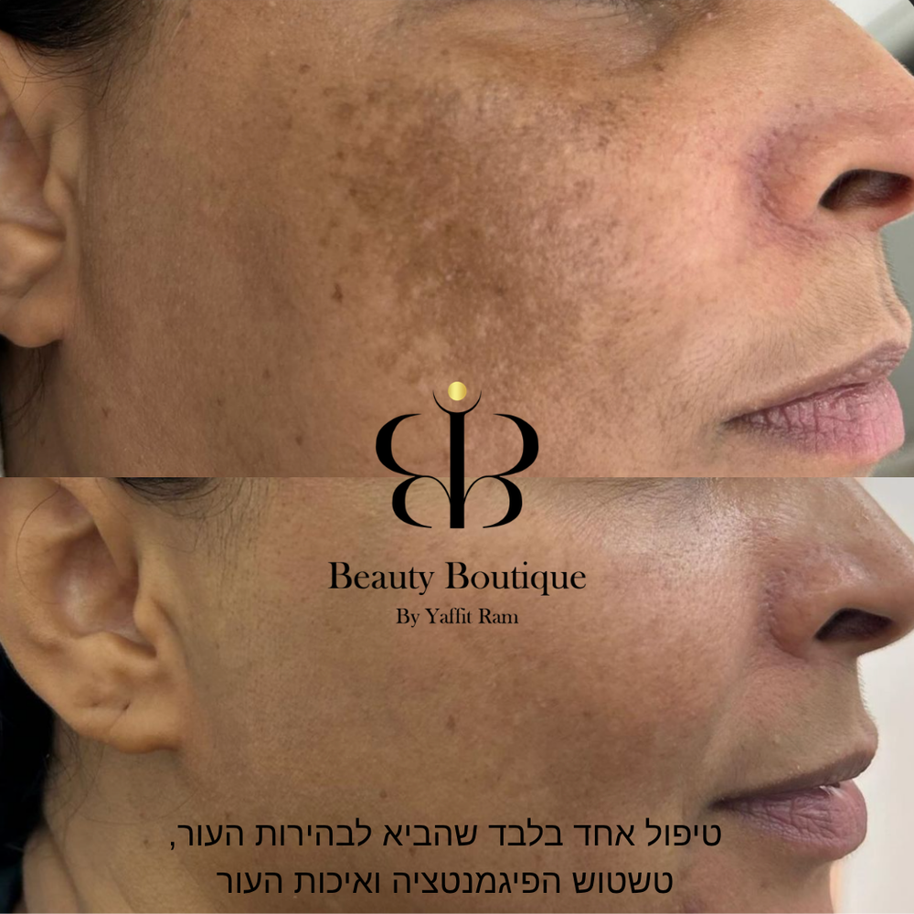 פיגמנטציה מסוג מלזמה - למה היא חוזרת? ואיך מנהלים אותה נכון לאורך זמן?